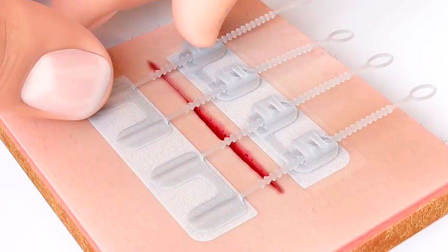 Inventan una nueva forma de cerrar heridas sin sutura |
